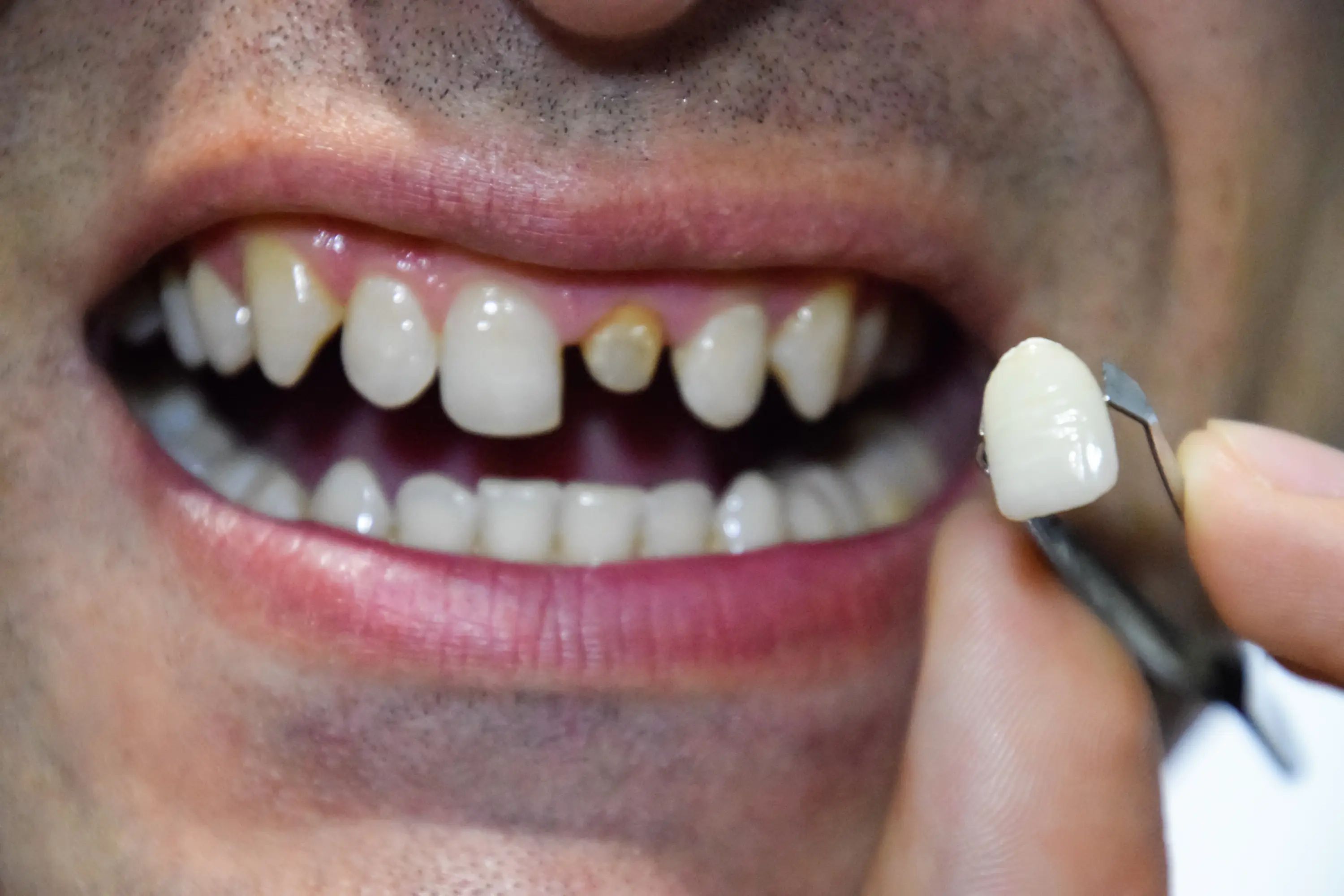 Zirconia Crowns
